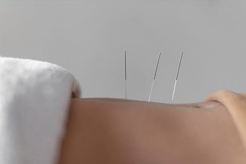 Acupuncture